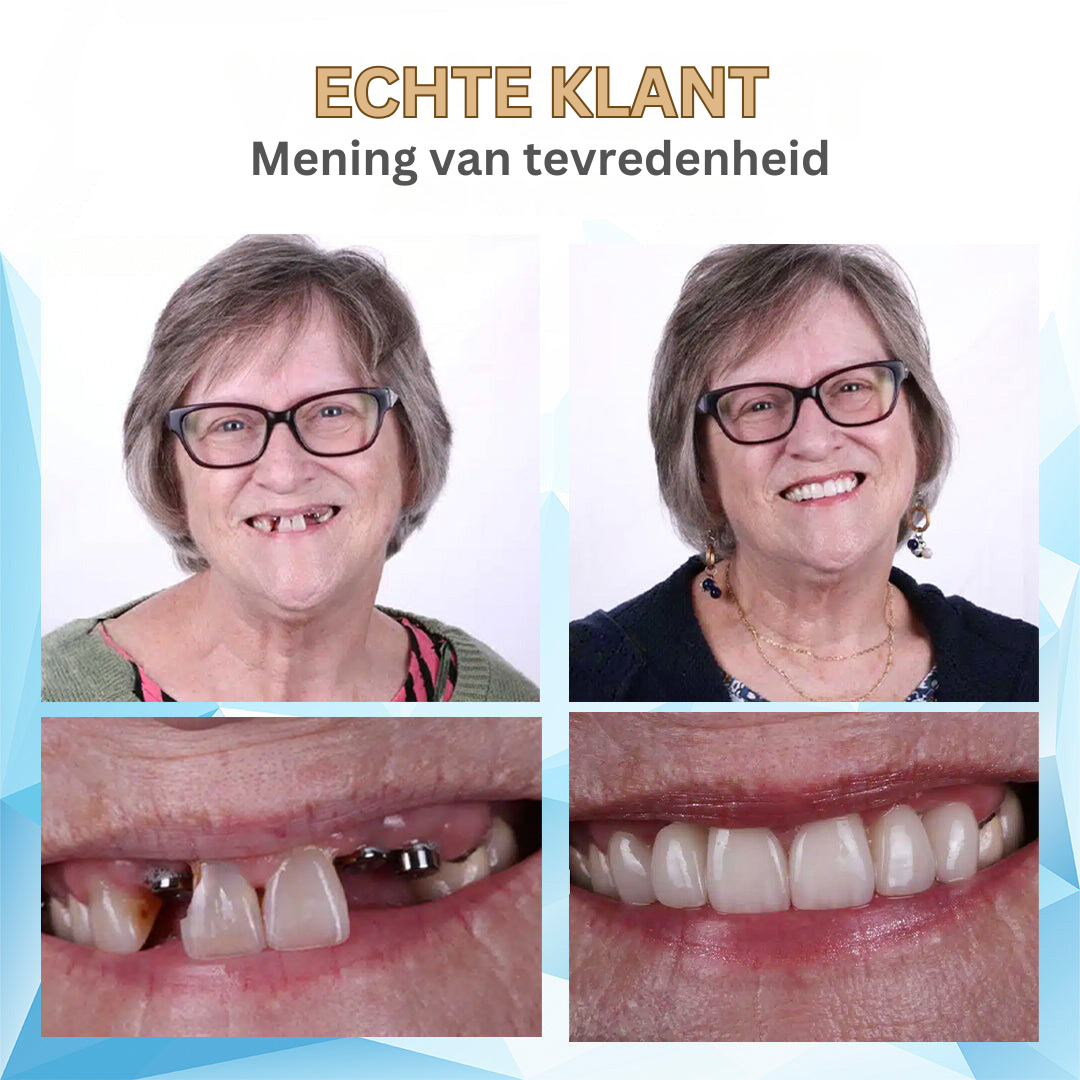 Moderne gebitsoplossing: comfortabel kunstgebit voor een natuurlijke glimlach en hernieuwd zelfvertrouwen.