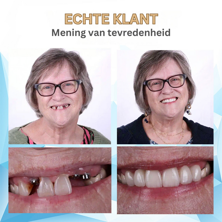 Moderne gebitsoplossing: comfortabel kunstgebit voor een natuurlijke glimlach en hernieuwd zelfvertrouwen.